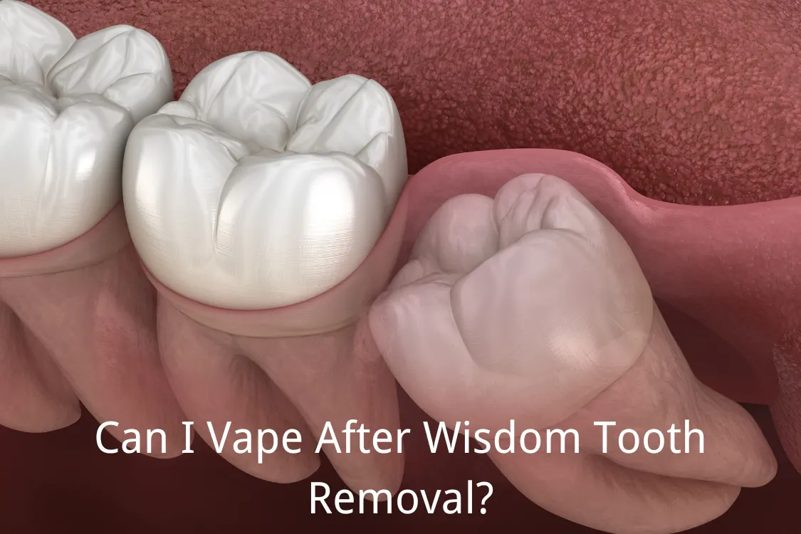 Can I Vape After Wisdom Tooth Removal SKE Vape Official Website