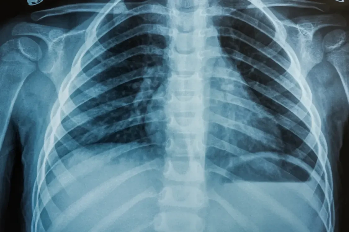 Can Vaping While Sick Really Cause Pneumonia?